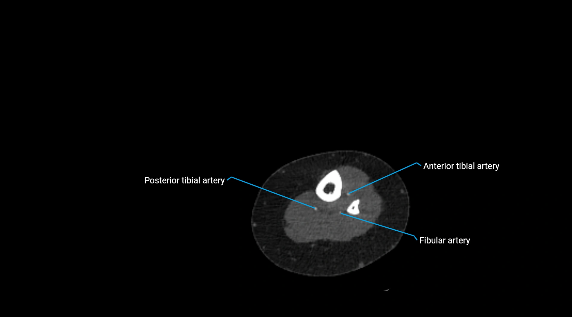 CTA lower limb cross sectional anatomy labelled image _226.webp